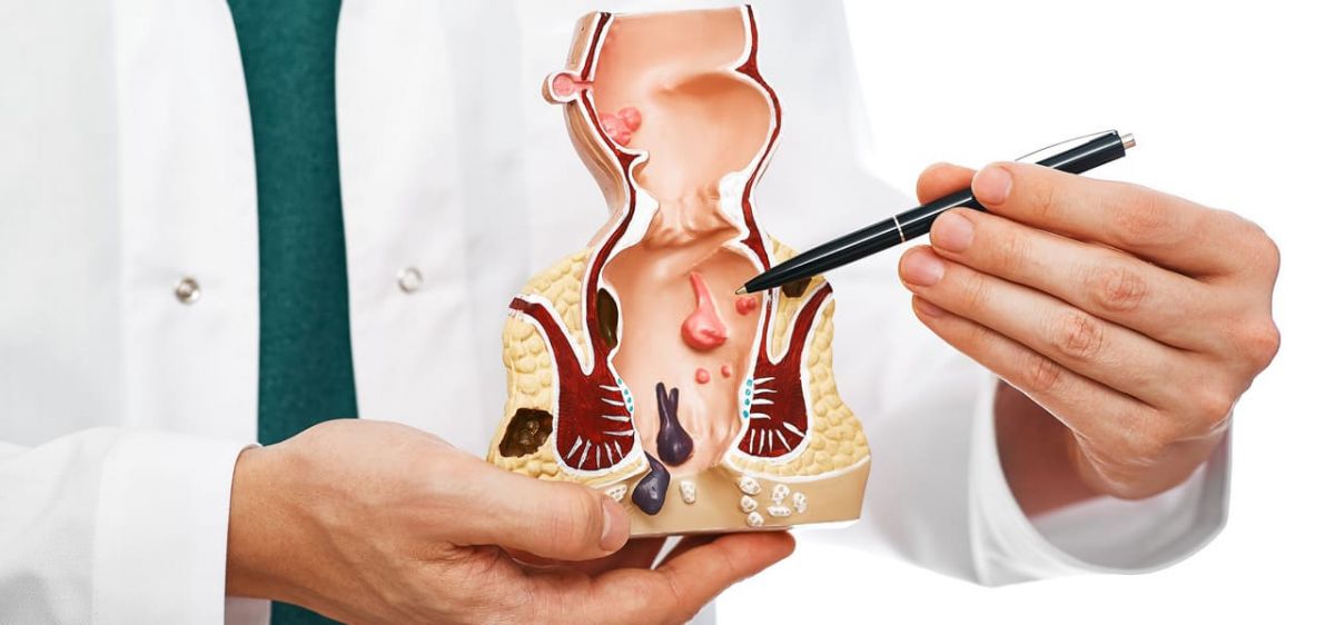 Treatment Options for External Hemorrhoids