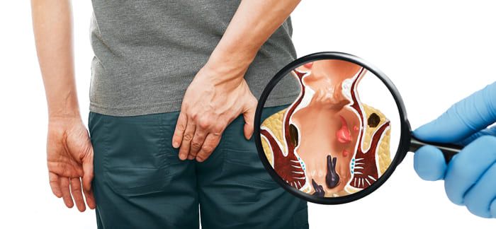What Causes External Hemorrhoids?