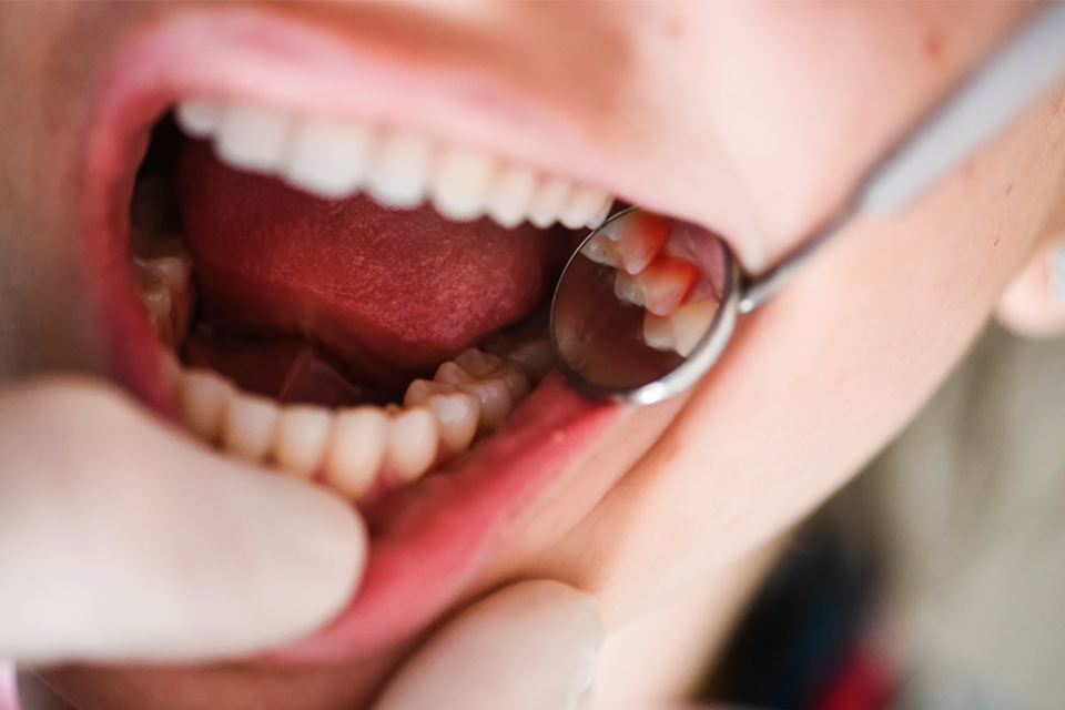 What to Do About Bleeding Gums