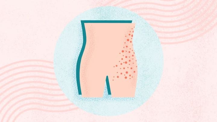 Living with Shingles: A Comprehensive Guide to Managing the Condition