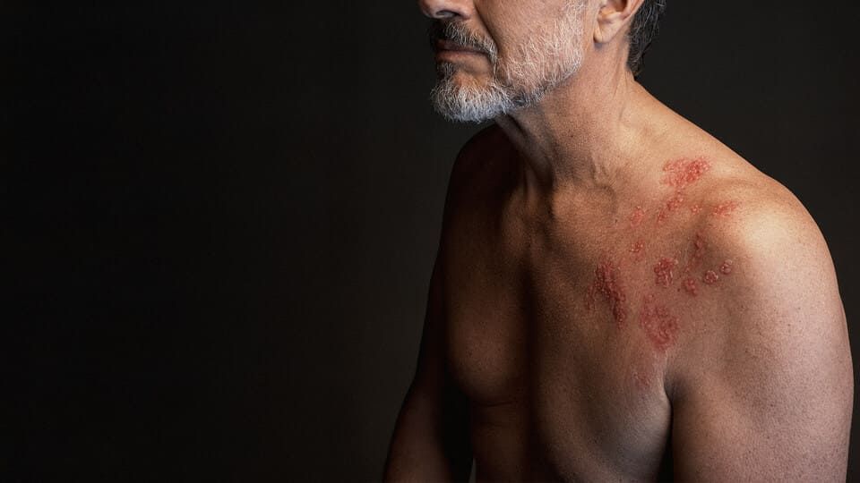 Shielding Yourself from Shingles: A Guide to Prevention